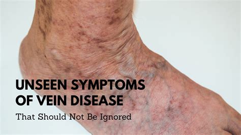 Symptoms Of Vein Disease That You Should Not Ignore