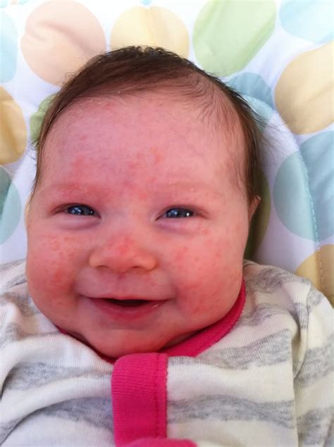 Hsv infection of the newborn may be acquired in utero, during birth, or after birth. babies acne - pictures, photos