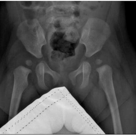 Radiographs Of The Childs Hip Joint Show Slightly Flat And Shallow