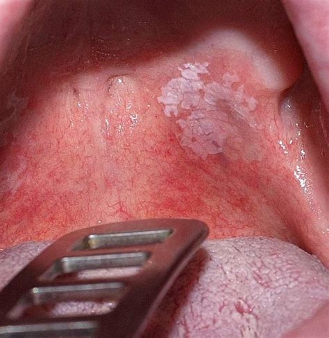 How To Get Rid Of Leukoplakia On Tongue Oral Leukoplakia Is The Most