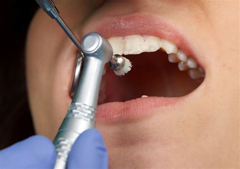 5 Benefits Of Getting A Professional Dental Cleaning