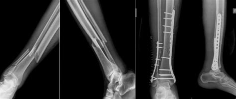 Pre And Post Operative X Rays Of Distal Tibia Fracture Treated With