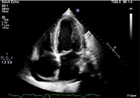 Transthoracic Echocardiogram Demonstrating Poor Ejection Fraction And