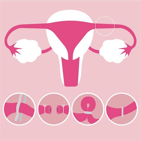 tubal ligation medical and science concept illustration 2204087 vector art at vecteezy