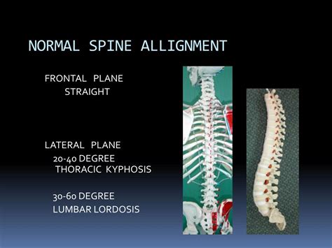 Ppt Spinal Deformities Powerpoint Presentation Free Download Id