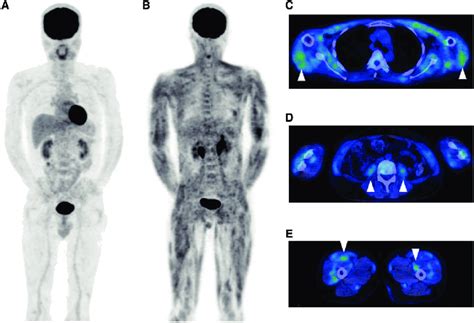Representative 18 F Fdg Petct Images In Patients With A Non Muscular