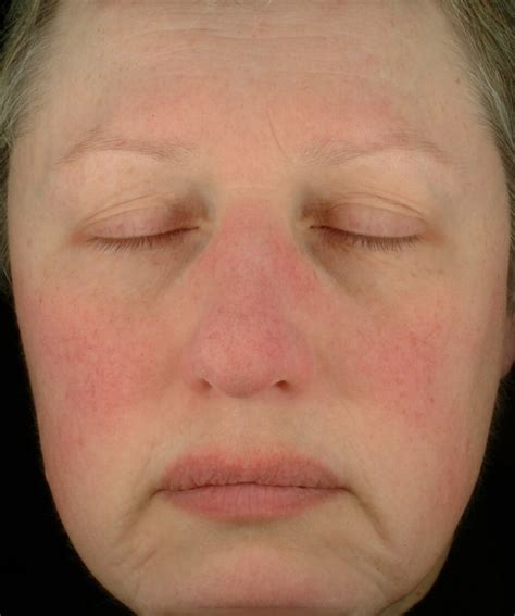 Erythematotelangiectatic Rosacea Dr Jerry Tan Acne And Rosacea