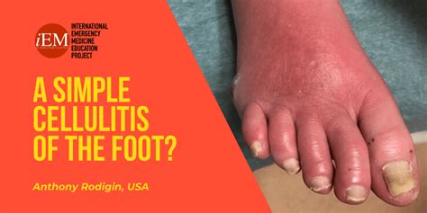 A Simple Cellulitis Of The Foot International Emergency Medicine