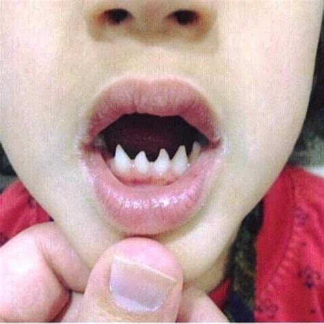 What Are Hutchinson Teeth News Dentagama