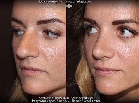 Rhinoplasty The Average Cost Of A Bulbous Nose Job Justinboey