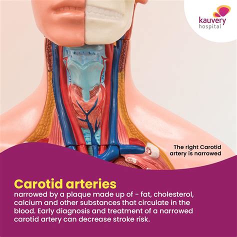 Symptoms Of Blocked Carotid Artery And Treatment