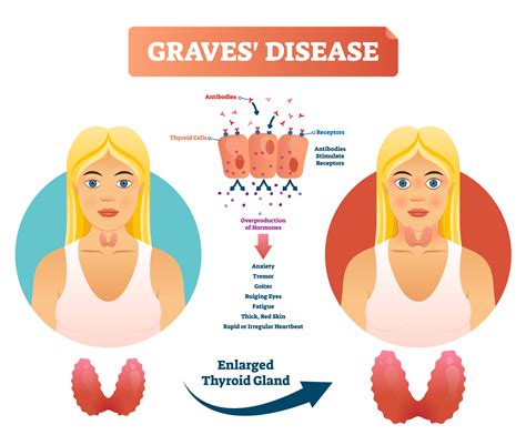 Graves' disease, also known as toxic diffuse goiter, is an autoimmune disease that affects the thyroid. What is Graves' disease? Causes, Symptoms, Diagnosis ...