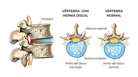Hernia Discal Síntomas Causas Y Tratamiento Neurocirujano Sevilla