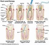 Images of Insurance Cover Root Canal