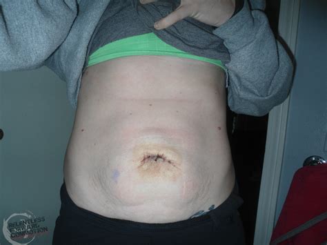 Maybe you would like to learn more about one of these? Adventures with Umbilical Hernia Surgery - The First 72 Hours.