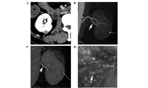 Preoperative Evaluation Of Renal Artery Anatomy Using Computed