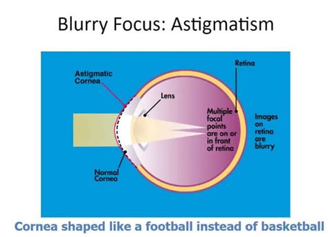 Astigmatism Correcting Lens Implant St Louis Pepose Vision