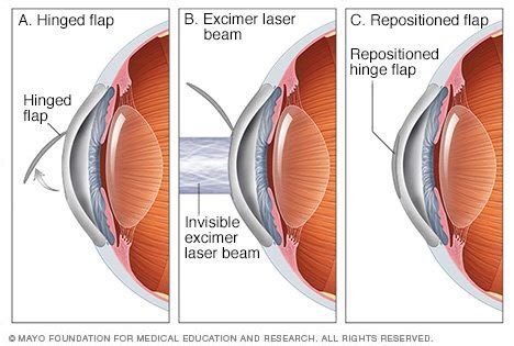 These tools are accurate enough to etch words into a human hair. LASIK eye surgery - Drugs.com