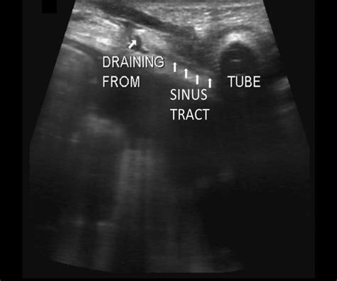 Two Tunnels For One Peritoneal Dialysis Catheter A Case For Caution