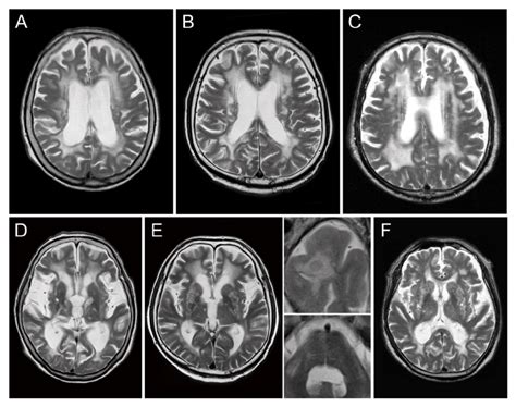 Representative Brain Mri Findings Of The Patients With Small Vessel