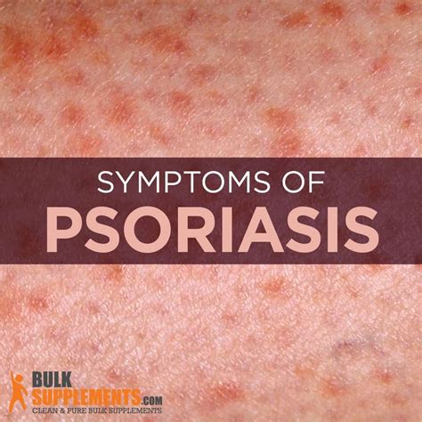 What Is Psoriasis Causes Symptoms And Treatment