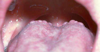 Bumps on Back of Tongue | Med Health Daily