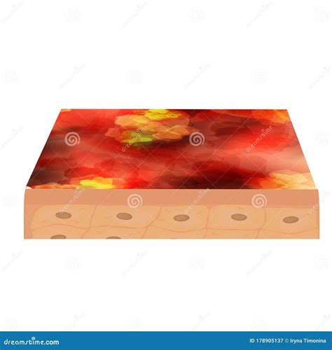 Cyst Acne. Furuncle Acne on the Skin Cysts and Pimples Stock Vector
