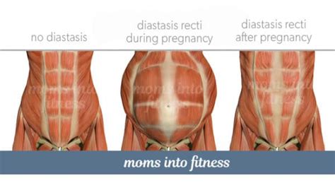 Diastasis Recti Dos And Donts During Pregnancy Two Specific Exercises