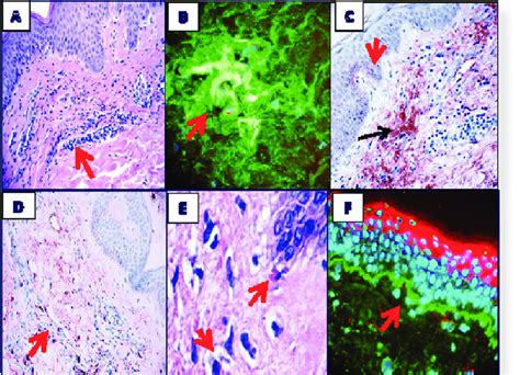 A Hande Staining Demonstrates A Mild Superficial Perivascular Dermal