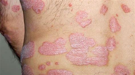 Psoriasis And Psoriatic Arthritis Associated With Obesity Dermatology