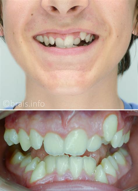 Un diente podrido no es solo un problema de adultos, también puede ocurrir en bebés, niños pequeños y niños. Extracción de dientes en ortodoncia infantil, ¿en quién ...
