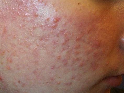 Blackheads Facts Causes And Treatment