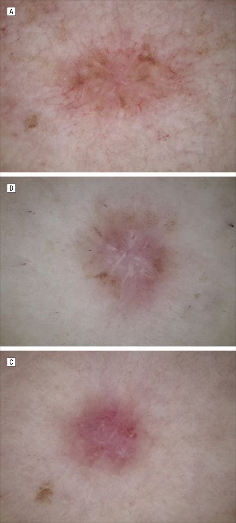 Conventional And Polarized Dermoscopy Features Of Dermatofibroma