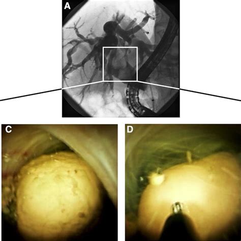 Biliary stone cases without a history of cancer were ascertained from the same hospitals and matched to index cancer cases on hospital, gender, and age (within 5 years). Digital single-operator video cholangioscopy in treating ...