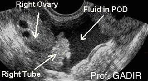 I copied it in part. Gynaecology Scans