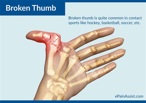 broken thumb treatment exercises causes symptoms risk factors