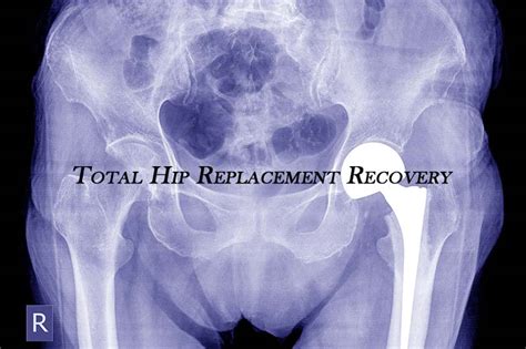 Total Hip Replacement Recovery And Surgery Complication Dr Vinil Shinde