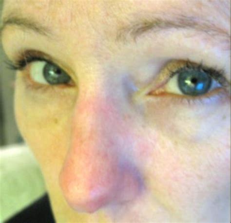 It should start getting better within 3 days and be fully healed within 3 weeks. Karla's Cottage: How can you tell if your nose is broken?