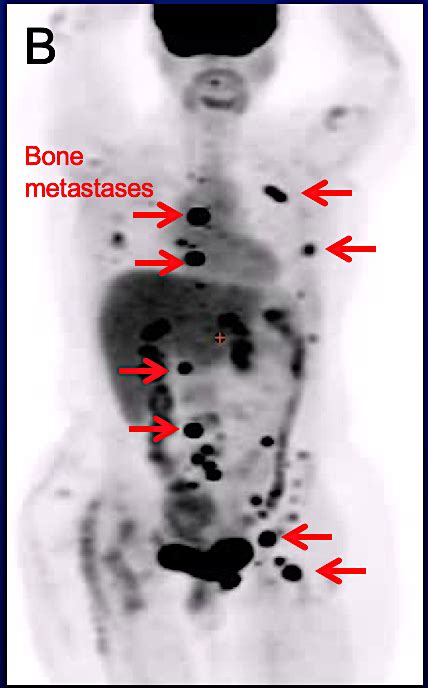 The risk associated with the thallium heart scans was shocking to me. Expert Opinion: Imaging and Lobular Breast Cancer - The ...