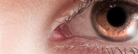 Sintomi Sindrome Dell Occhio Secco
