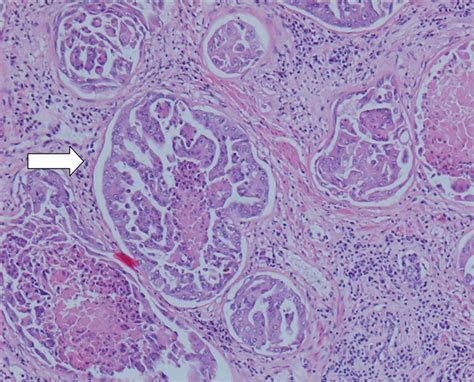 Canine Prostate Carcinoma Four Clinical Cases In Sexually Intact And