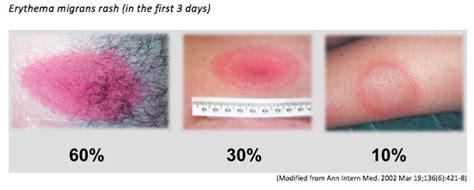 Early stage hantavirus rash pictures. What We Know About Lyme Disease. - EMOttawa Blog