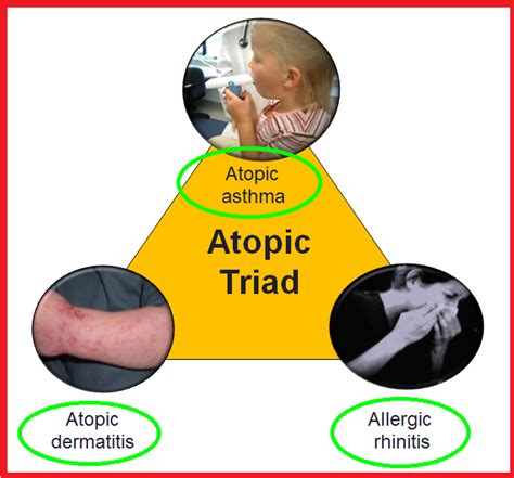 Atopic Triad 1asthma 2eczema Medicine E Library Facebook