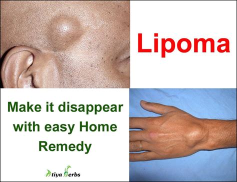 Lipoma What It Is Causes Symptoms Types Treatment 48 Off