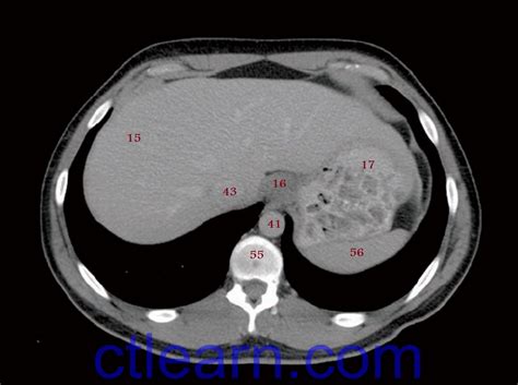 (a) ct section through male perineum; Learn CT Scan: Anatomy CT Axial Abdomen and Pelvis Male
