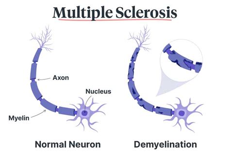 How Does Multiple Sclerosis Affect The Body Ausmed