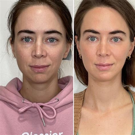 Botox And Filler Before And Afters The Perfect Dose