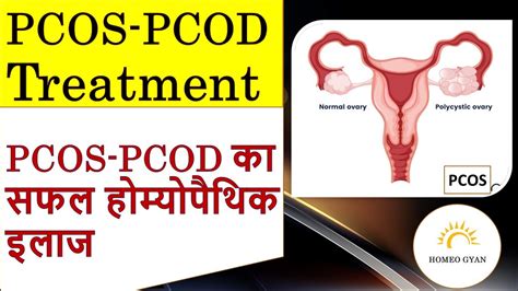 Homeopathy Treatment For Pcos Pcod Homeopathy Treatment Homeopathy