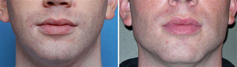 Standard Chin And Jaw Angle Implants Result Front View Dr Barry Eppley