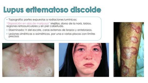 Lupus Eritematoso Discoide